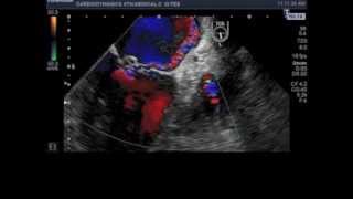 mitral valve prolapse of posterior leaflet middle scallop P2 [upl. by Akinorev]