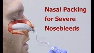 Nasal Packing for Severe Nosebleeds [upl. by Amor635]