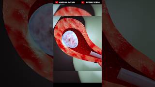 Vacuum Aspiration Abortion Explained in 3D🔥🔥 shorts abortion [upl. by Cleopatra]