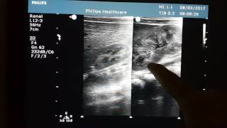 Neonatal Sonography  Right Hypoplastic Kidney [upl. by Nodababus333]