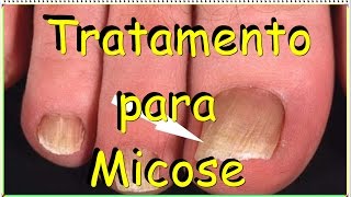 🔴Tratamento para Micose  Dicas do Marido [upl. by Karole]