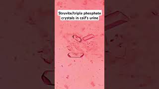 urinary crystalsstruvitetriple phosphateMAP [upl. by Nirhtak]