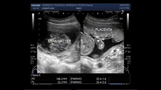 Ultrasound Video showing Anencephaly in a Pregnancy of about 20 weeks [upl. by Bjork550]