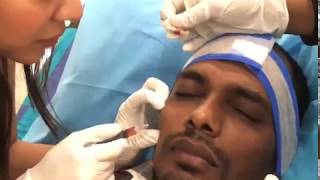 Under Eye PRF Injections By DR Nidhi Gupta [upl. by Nanoc]