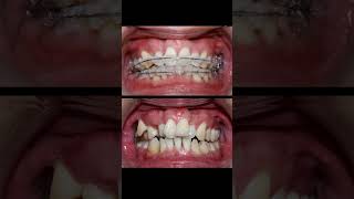 Braces process 3 years braces niengrang dentist [upl. by Airdnola626]