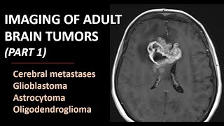 Imaging of brain tumors part 1 metastases glioblastoma and beyond [upl. by Ladnyc]