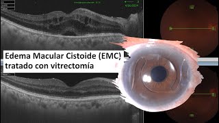 Edema Macular Cistoide EMC  Edema Macular Quístico  Vitrectomía  IrvineGass Syndrome [upl. by Eidnalem267]