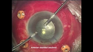 Endophthalmitis After Cataract Surgery Khaled A Shalaby MD [upl. by Riegel]