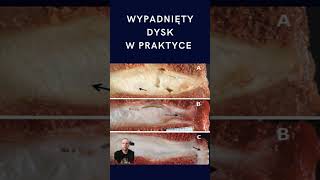 Dysk mi wypadł [upl. by Rokach]