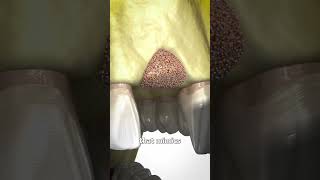 Bone Grafting Explained 🤔 [upl. by Zawde]