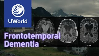 Frontotemporal Dementia vs Alzheimer Disease with Histology  UWorld USMLE MBBS [upl. by French]