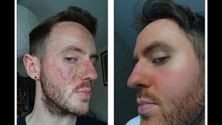 How Matt Healed his Eczema and Overcame Topical Steroid Withdrawal [upl. by Yblok]