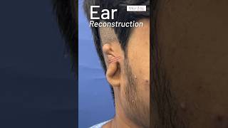 Ear Reconstruction Surgery Results Before amp After  Microtia in Mumbai  designerbodyz [upl. by Teiv646]