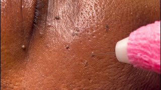 Amazing before and after DPN Dermatosis Papulosa Nigra Removal [upl. by Baxy378]