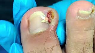 Deep Ingrown Nail Causes Serious Infection and Make Patient Uncomfortable To Walk [upl. by Ana]