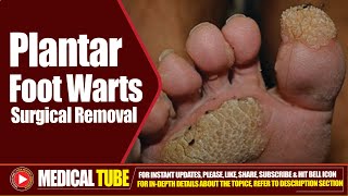 Foot Plantar Warts  Surgical Removal Treatment  How to Remove Plantar Warts ❌🦠 [upl. by Lock412]