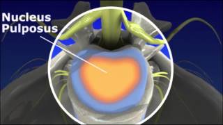 Herniated Disc  Pain Management [upl. by Annaya824]