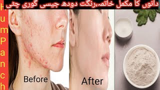 Best Face Pack For Acne Treatment Naturally l Home Remedies For Acne l Glass Skin Home Remedies [upl. by O'Kelly]