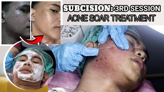 THIRD SESSION SUBCISION FOR ACNE SCARS  3 IN 1 SYNERGISTIC ACNE SCAR TREATMENT  3RD SESSION [upl. by Mathi]