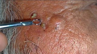 sac be spa blackheads elderly 2024  sac dep spa boy age blackheads 2024  sac be spa face today new [upl. by Curzon]