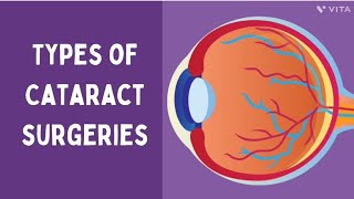 Types of cataract surgeries ophthalmology  NEETPG [upl. by Dennis375]