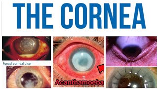 Cornea 8 Major Topic Herpes Zoster Ophthalmicus [upl. by Okun]