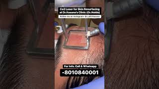 co2 laser treatment for acne scars  DrLalit Kasanas [upl. by Attolrahc]