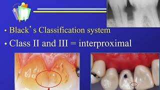 Dr GV Blacks Classification of Dental Caries and Restorations [upl. by Eirene]