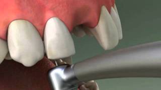 Dentist  Maryland Bridge Procedure [upl. by Eletnahs]