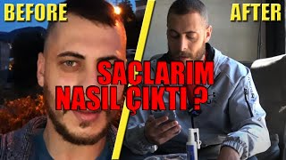 Saçlarım Nasıl Çıktı  Minoxil Kullanımı  Sizden Gelenler [upl. by Larrisa]