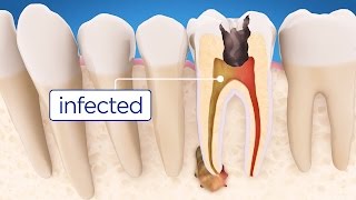 Root Canal Treatment Step by Step [upl. by Karylin734]