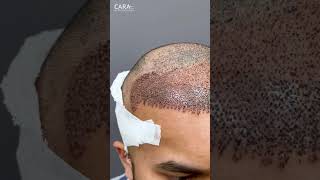 Experience WORLD CLASS Hair Transplant at Cara Clinic Mumbai [upl. by Eelrak]