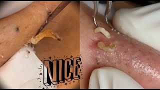 Ultimate Blackhead Extraction  Satisfying Acne Skincare Treatment 😍 [upl. by Cissie]