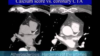 UCSF Radiology Calcium Scoring vs Coronary CTA Scan [upl. by Namzzaj]