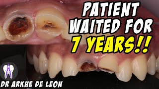 Amazing Case of Fractured Teeth Restored with Zirconia Crown 4k C29 [upl. by Nnagrom417]