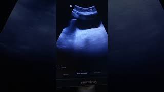 Left Adnexal simple cyst Ultrasound video shorts [upl. by Elockcin]