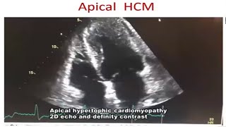 Cardiomyopathy Echo by Prof Dr Tuhin Haque madam [upl. by Annahael]