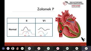 Warsztaty EKG  kurs podstawowy 2 Morfologia P arytmie przedsionkowe [upl. by Riabuz]