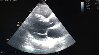 First degree AV block on echocardiography [upl. by Blythe]