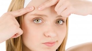 How to Get Rid of Forehead Acne Acne Scars Treatment Removal Medication Cure Home Remedies [upl. by Stern425]