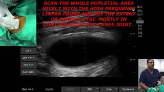 USG ULTRASOUND GUIDED BAKERS POPLITEAL CYST ASPIRATION [upl. by Nerfe862]