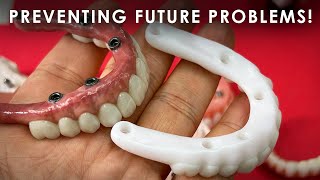 Preventing Future Problems with Full Mouth Implants [upl. by Zoarah]