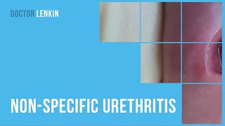 😟 Nonspecific urethritis [upl. by Lletnahs]