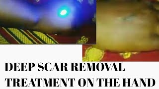 Deep SCAR REMOVAL TREATMENT ON THE HAND UP CLOSE VEIW [upl. by Marysa]