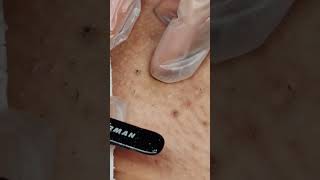 10 Minutes of Ingrown hair removal BIKINI AREA [upl. by Nerhe]