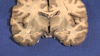 Hypothalamus Neuroanatomy Video Lab  Brain Dissections [upl. by Stoops419]