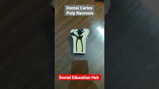 Dental Caries Teeth Model  Cavities in teeth [upl. by Hailee]