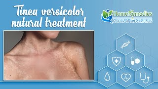 Tinea versicolor natural treatment – coconut oil and aloe vera [upl. by Sardse772]