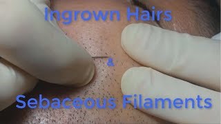 Ingrown Hairs and Sebaceous Filaments [upl. by Ahse805]