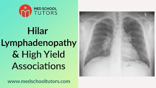 CXRs Hilar Lymphadenopathy and High Yield Associations for the USMLE [upl. by Rodmur]